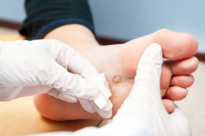 Plantar Wart Removal Houston