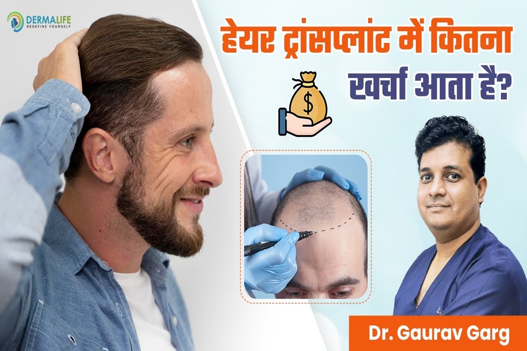 What Are The Cost Factors Of Hair Transplant In Delhi